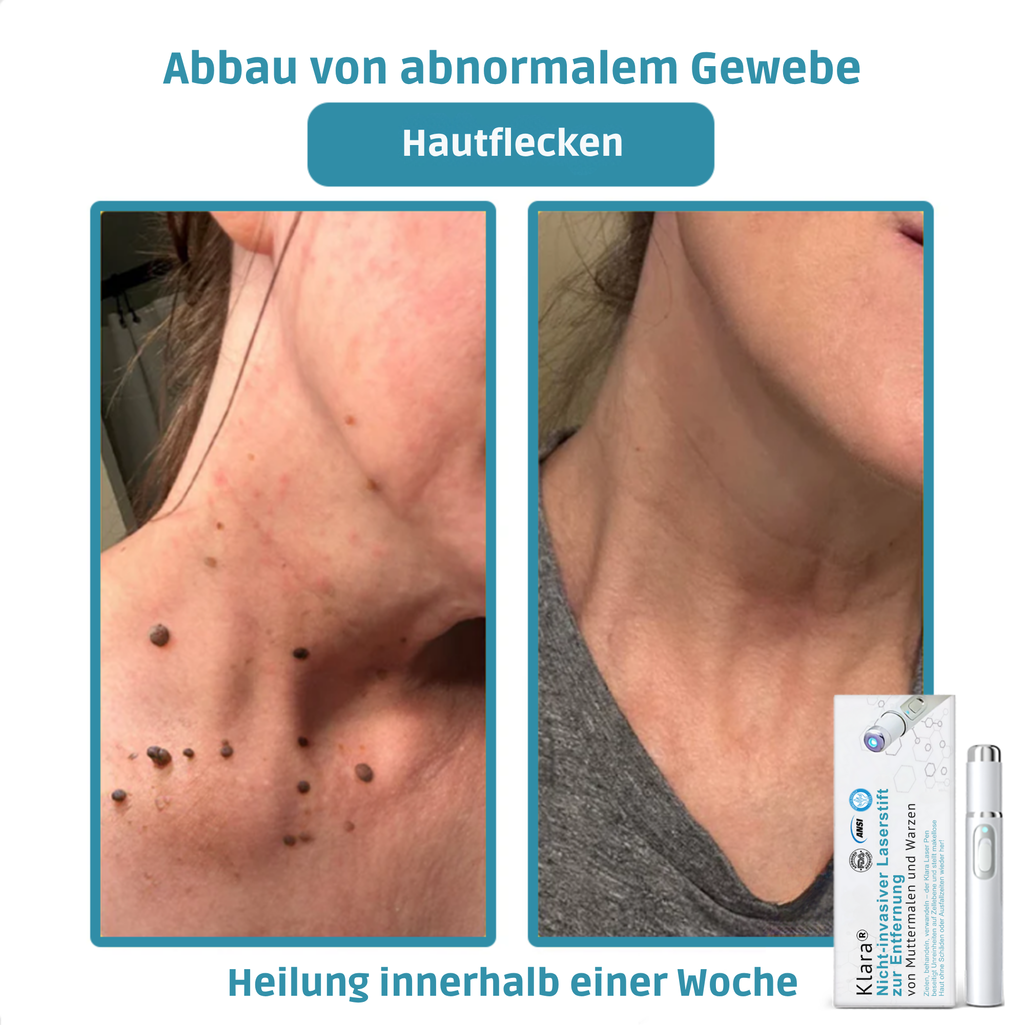 Hautpflege Gerät Für Kosmetische Anwendung Zuhause product image 5