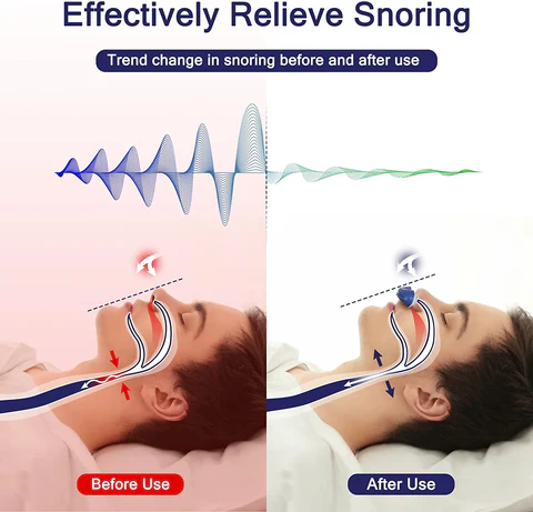 Nasal snoring stopper device - mask-free and USB-rechargeable