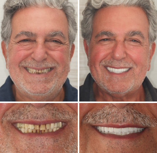 Zahnersatz Flexibel Set Für Temporäre Kosmetische Anwendung product image 5